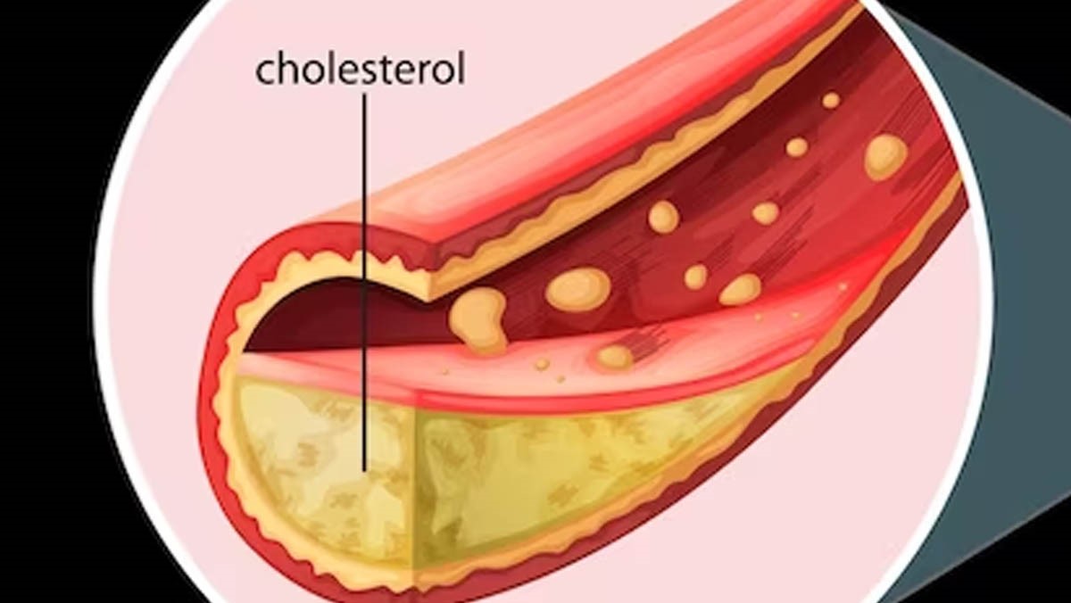  Tanda-tanda Tubuh yang Menunjukkan Kebanyakan Kolesterol (Sumber foto : Disway)