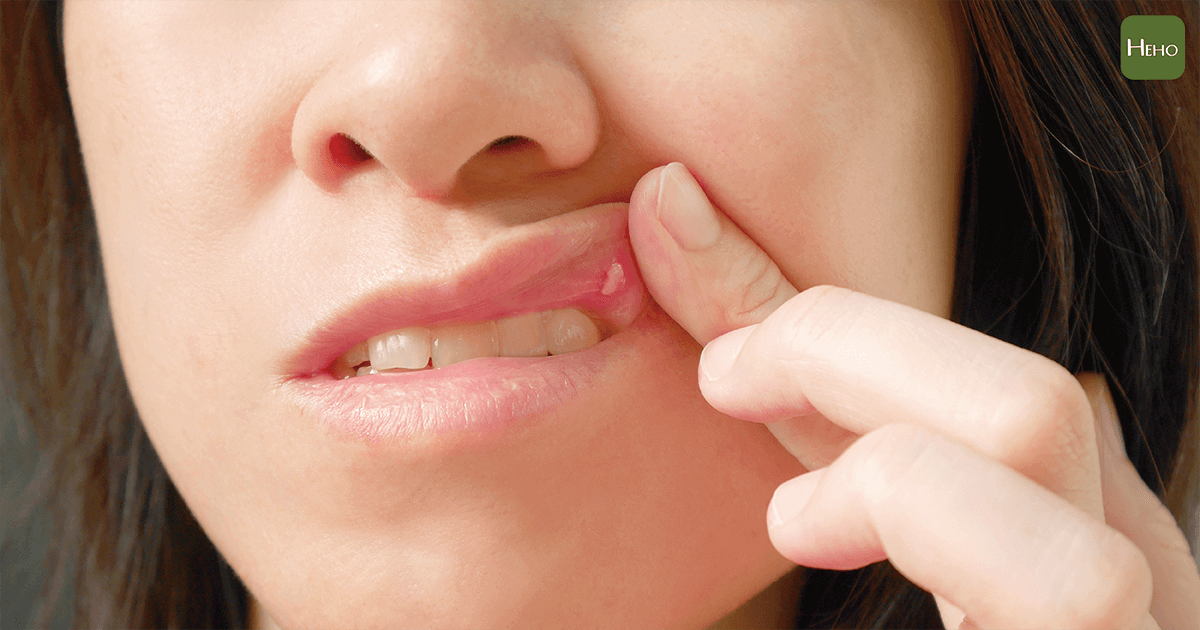 Applying salt to a mouth ulcer is cruel; a doctor's clever trick heals it in 3 days!