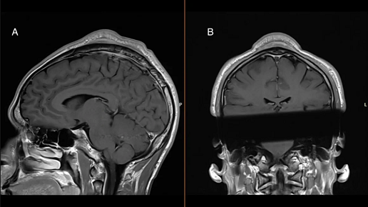 An MRI of a breaker's head shows the tumor that doctors believe developed due to repeated headspins.  BMJ Case Reports 2024