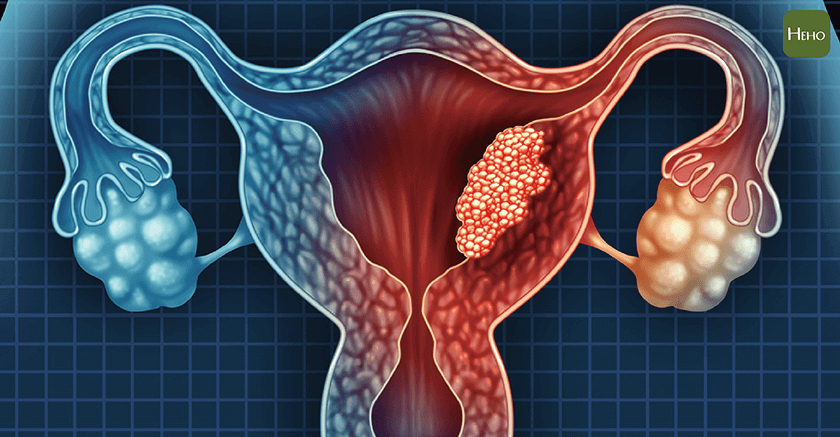 Increasing Cases of Endometrial Cancer: Early Detection and Treatment