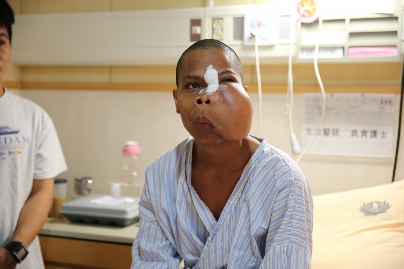  Filipino Michael Mahusay had a 12 cm tumor on the face.  Attribute: Liberty Times