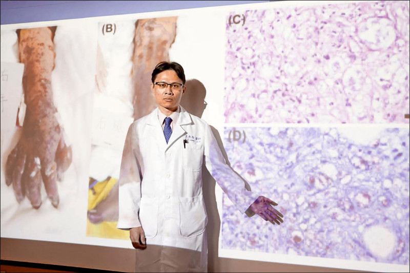 Dr Wang Yongzhi menunjukkan bahwa penyakit Han ditularkan melalui saluran pernapasan, dan tingkat infeksinya tidak tinggi, tetapi masa inkubasinya selama 2 hingga 20 tahun.  (Sumber foto : Tri-Service General Hospital)